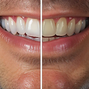 misfarvede tænder før og efter