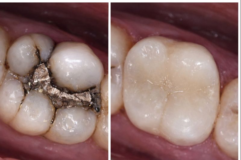 skift fra sølv til plast
